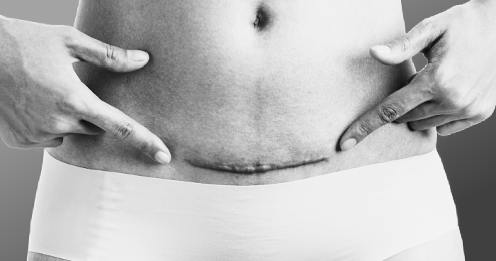 Keloid scar from c-section image